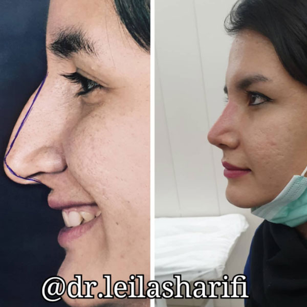 نمونه جراحی بینی دکتر لیلا شریفی
