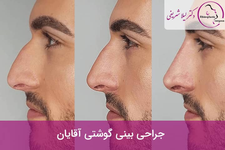همه چیز در مورد جراحی بینی گوشتی + قیمت و نمونه کار - دکتر لیلا شریفی