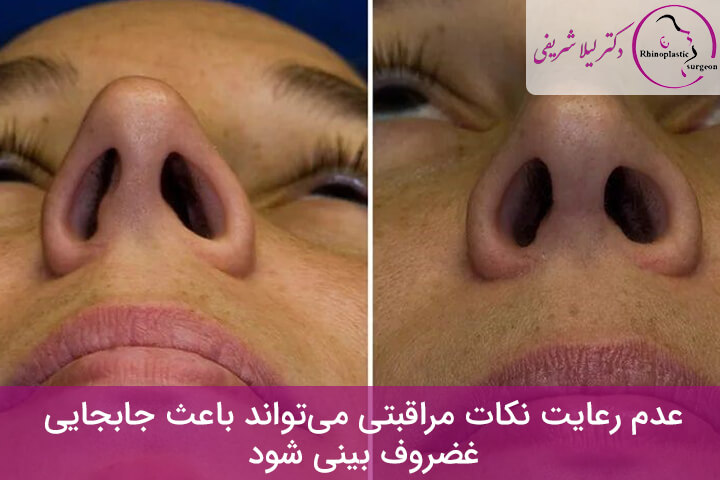 جابجایی غضروف بعد از عمل بینی